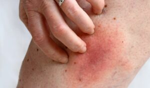 Obrzęk i reakcje alergiczne – kiedy ukąszenia pluskiew są niebezpieczne?